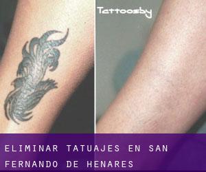 Eliminar tatuajes en San Fernando de Henares