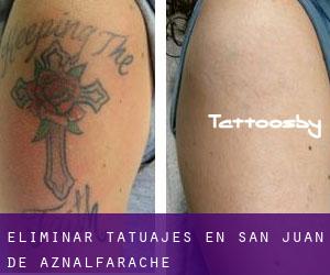 Eliminar tatuajes en San Juan de Aznalfarache