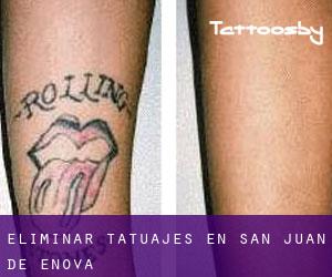 Eliminar tatuajes en San Juan de Énova