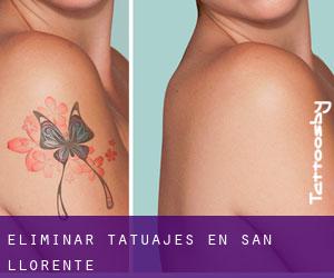 Eliminar tatuajes en San Llorente