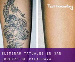 Eliminar tatuajes en San Lorenzo de Calatrava