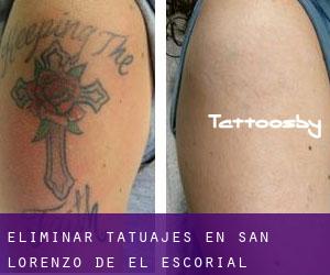Eliminar tatuajes en San Lorenzo de El Escorial