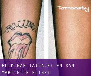 Eliminar tatuajes en San Martín de Elines
