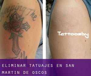 Eliminar tatuajes en San Martín de Oscos