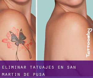 Eliminar tatuajes en San Martín de Pusa