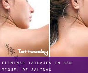 Eliminar tatuajes en San Miguel de Salinas