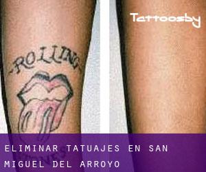Eliminar tatuajes en San Miguel del Arroyo