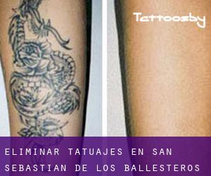 Eliminar tatuajes en San Sebastián de los Ballesteros