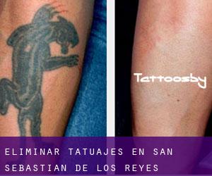 Eliminar tatuajes en San Sebastián de los Reyes