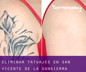 Eliminar tatuajes en San Vicente de la Sonsierra