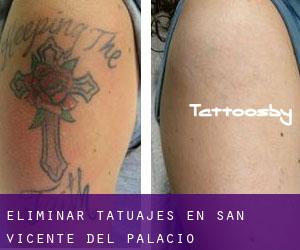 Eliminar tatuajes en San Vicente del Palacio