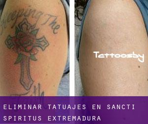 Eliminar tatuajes en Sancti-Spíritus (Extremadura)