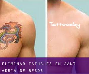 Eliminar tatuajes en Sant Adrià de Besòs