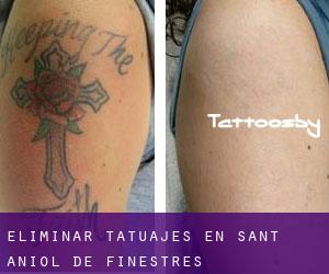 Eliminar tatuajes en Sant Aniol de Finestres