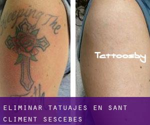 Eliminar tatuajes en Sant Climent Sescebes