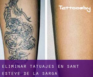 Eliminar tatuajes en Sant Esteve de la Sarga
