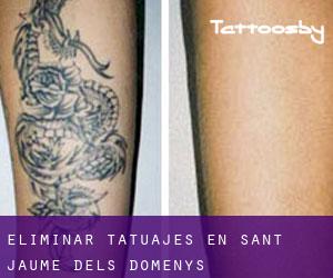 Eliminar tatuajes en Sant Jaume dels Domenys