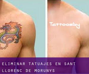 Eliminar tatuajes en Sant Llorenç de Morunys