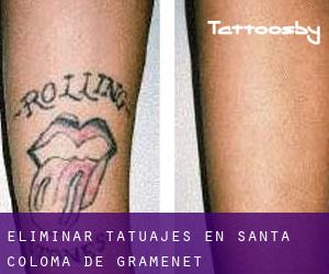 Eliminar tatuajes en Santa Coloma de Gramenet