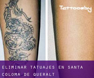 Eliminar tatuajes en Santa Coloma de Queralt