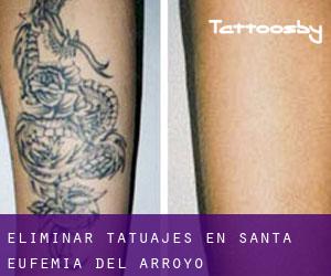 Eliminar tatuajes en Santa Eufemia del Arroyo