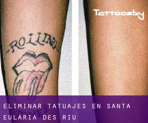 Eliminar tatuajes en Santa Eulària des Riu