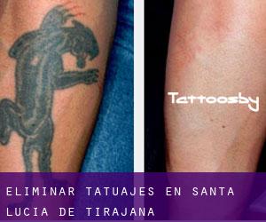 Eliminar tatuajes en Santa Lucía de Tirajana