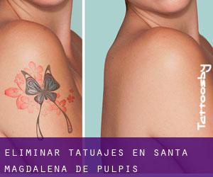 Eliminar tatuajes en Santa Magdalena de Pulpis