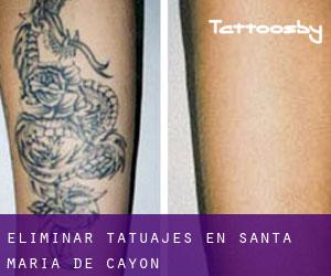 Eliminar tatuajes en Santa María de Cayón