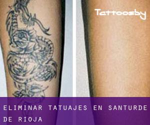 Eliminar tatuajes en Santurde de Rioja