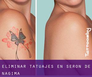 Eliminar tatuajes en Serón de Nágima