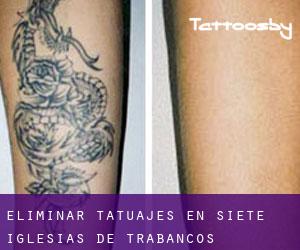 Eliminar tatuajes en Siete Iglesias de Trabancos