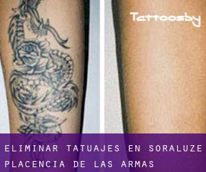 Eliminar tatuajes en Soraluze / Placencia de las Armas