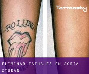 Eliminar tatuajes en Soria (Ciudad)