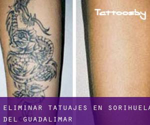 Eliminar tatuajes en Sorihuela del Guadalimar