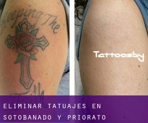 Eliminar tatuajes en Sotobañado y Priorato