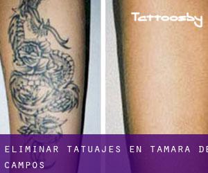 Eliminar tatuajes en Támara de Campos