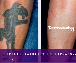 Eliminar tatuajes en Tarragona (Ciudad)