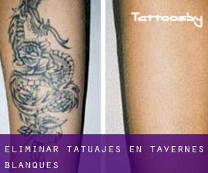 Eliminar tatuajes en Tavernes Blanques
