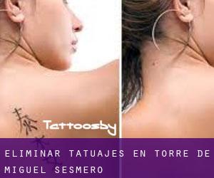 Eliminar tatuajes en Torre de Miguel Sesmero