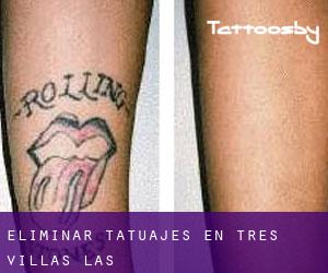 Eliminar tatuajes en Tres Villas (Las)