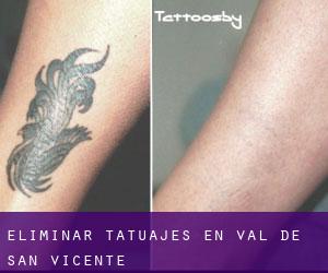Eliminar tatuajes en Val de San Vicente