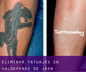 Eliminar tatuajes en Valdepeñas de Jaén