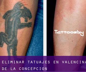 Eliminar tatuajes en Valencina de la Concepción