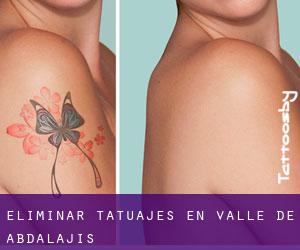 Eliminar tatuajes en Valle de Abdalajís
