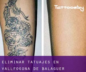 Eliminar tatuajes en Vallfogona de Balaguer