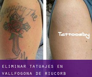 Eliminar tatuajes en Vallfogona de Riucorb