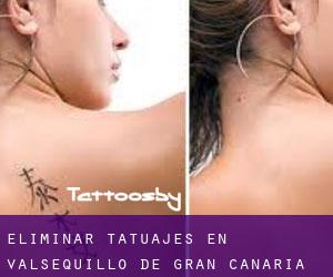 Eliminar tatuajes en Valsequillo de Gran Canaria