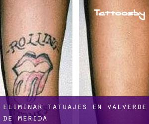 Eliminar tatuajes en Valverde de Mérida