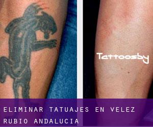 Eliminar tatuajes en Velez Rubio (Andalucía)